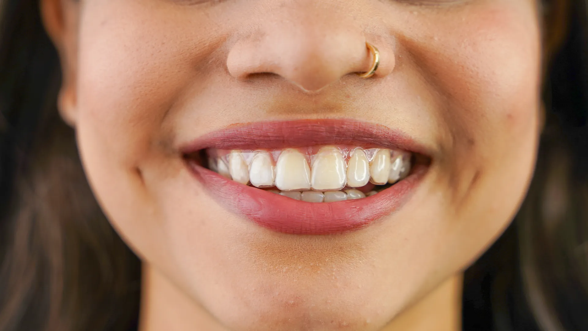 close-up comparison showing clear aligners are nearly invisible on teeth