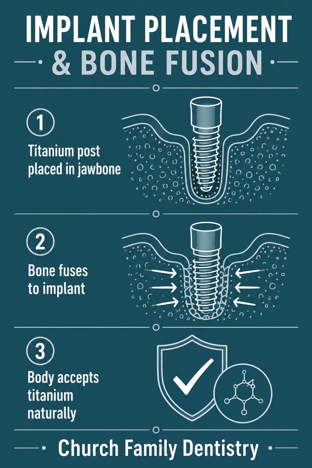 Implant Placement